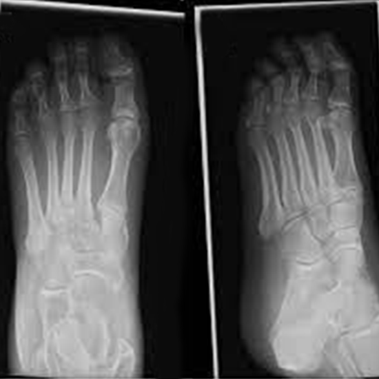 x-ray feet ap view test